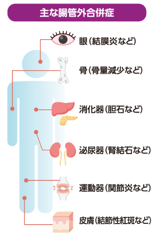 主な腸管合併症