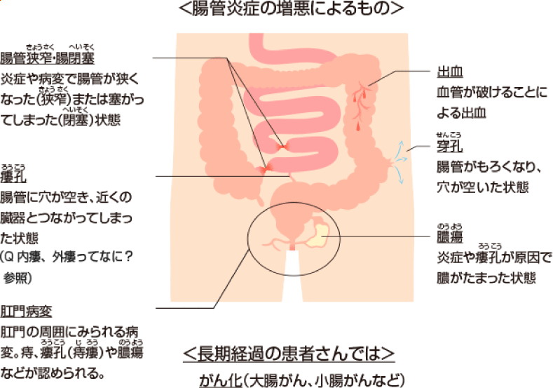 クローン病の主な腸管合併症