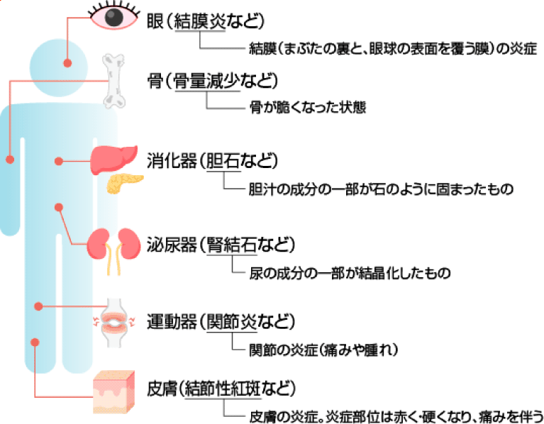 関節痛の見通し