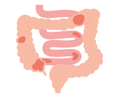 小腸大腸型