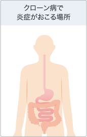 クローン病で炎症が起こる場所