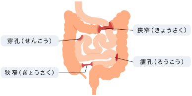 図1:クローン病の腸管合併症