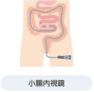 クローン病の検査：小腸内視鏡