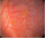 【潰瘍性大腸炎のタイプ】内視鏡所見による分類 1）正常粘膜