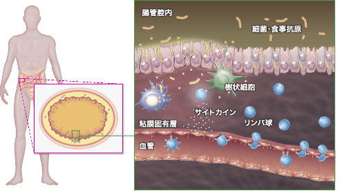 【潰瘍性大腸炎ってどんな病気？】腸の粘膜におけるリンパ球とサイトカインの様子