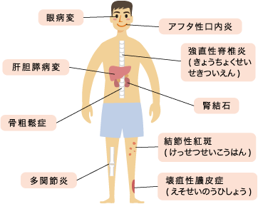潰瘍性病変
